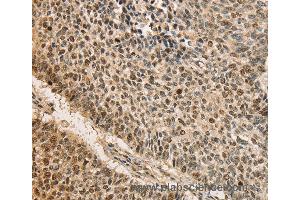 Immunohistochemistry of Human lung cancer using CDCA8 Polyclonal Antibody at dilution of 1:40 (CDCA8 antibody)