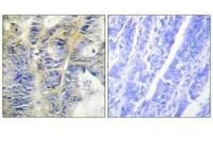 Immunohistochemistry analysis of paraffin-embedded human colon carcinoma tissue using Collagen IV α5 antibody. (COL4a5 antibody)