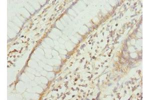 Immunohistochemistry of paraffin-embedded human colon cancer using ABIN7166573 at dilution of 1:100 (COX1 antibody  (AA 1-160))