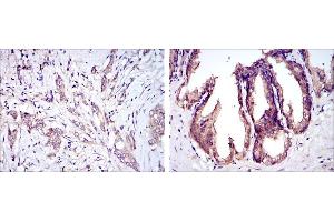Immunohistochemical analysis of paraffin-embedded breast cancer tissues (left) and prostate tissues (right) using MAP3K5 mouse mAb with DAB staining. (ASK1 antibody)
