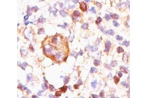IHC testing of Hodgkin's lymphoma stained with Bcl-X antibody (BX006). (BCL2L1 antibody)