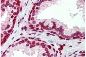 Human Prostate (formalin-fixed, paraffin-embedded) stained with BXDC5 antibody ABIN462228 followed by biotinylated goat anti-rabbit IgG secondary antibody ABIN481713, alkaline phosphatase-streptavidin and chromogen. (RPF1 antibody  (AA 45-94))