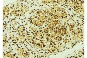 ABIN6276841 at 1/100 staining Human breast cancer tissue by IHC-P.