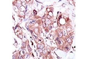 IHC analysis of FFPE human breast carcinoma tissue stained with the ERBB4 antibody (ERBB4 antibody  (AA 1276-1308))