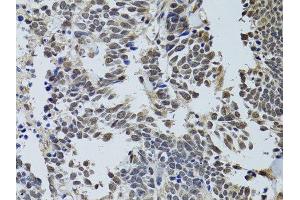 Immunohistochemistry of paraffin-embedded human lung cancer using STK11 antibody. (LKB1 antibody  (AA 134-433))