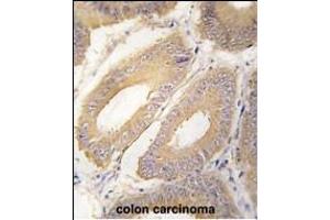 Formalin-fixed and paraffin-embedded human colon carcinoma tissue reacted with FGF4 Antibody (C-term) (ABIN392776 and ABIN2842218) , which was peroxidase-conjugated to the secondary antibody, followed by DAB staining. (FGF4 antibody  (C-Term))