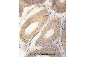 Formalin-fixed and paraffin-embedded human colon carcinoma tissue reacted with FGF4 Antibody (C-term) (ABIN392776 and ABIN2842218) , which was peroxidase-conjugated to the secondary antibody, followed by DAB staining.
