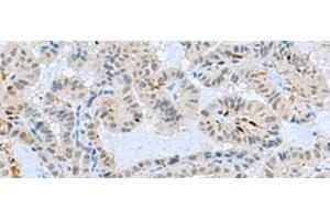 Immunohistochemistry of paraffin-embedded Human thyroid cancer tissue using TCF19 Polyclonal Antibody at dilution of 1:60(x200) (TCF19 antibody)