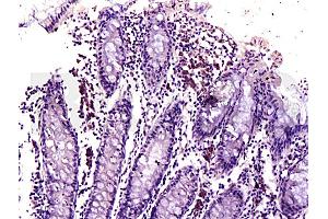 Formalin-fixed and paraffin embedded human colon labeled with Anti-DR3/APO3/TWEAK Polyclonal Antibody, Unconjugated (ABIN668421) at 1:200, followed by conjugation to the secondary antibody and DAB staining (DR3/LARD antibody  (AA 351-417))