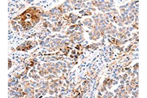 The image on the left is immunohistochemistry of paraffin-embedded Human breast cancer tissue using ABIN7190683(FOXD2 Antibody) at dilution 1/10, on the right is treated with synthetic peptide. (FOXD2 antibody)