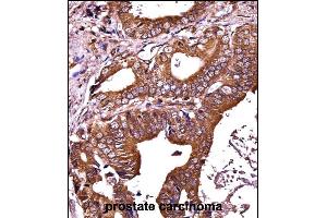 RIPK1 Antibody (N-term) ((ABIN657814 and ABIN2846781))immunohistochemistry analysis in formalin fixed and paraffin embedded human prostate carcinoma followed by peroxidase conjugation of the secondary antibody and DAB staining. (RIPK1 antibody  (N-Term))