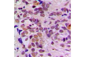 Immunohistochemical analysis of ATF1 staining in human breast cancer formalin fixed paraffin embedded tissue section. (AFT1 antibody  (C-Term))