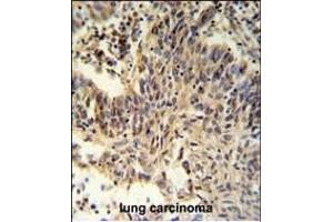 RXRA Antibody (Center) (ABIN651113 and ABIN2840079) IHC analysis in formalin fixed and paraffin embedded lung carcinoma followed by peroxidase conjugation of the secondary antibody and DAB staining. (Retinoid X Receptor alpha antibody  (AA 196-224))