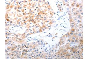 The image on the left is immunohistochemistry of paraffin-embedded Human lung cancer tissue using ABIN7191313(LPPR5 Antibody) at dilution 1/20, on the right is treated with synthetic peptide.