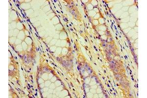 Immunohistochemistry of paraffin-embedded human colon cancer using ABIN7171365 at dilution of 1:100 (CD2 antibody  (AA 25-209))