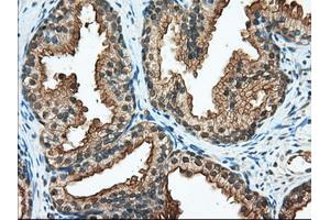 Immunohistochemical staining of paraffin-embedded Adenocarcinoma of Human ovary tissue using anti-RANGAP1 mouse monoclonal antibody. (RANGAP1 antibody)