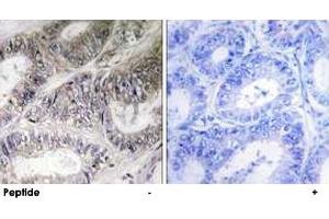 Immunohistochemistry analysis of paraffin-embedded human colon carcinoma tissue using COX19 polyclonal antibody . (COX19 antibody)