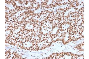 Formalin-fixed, paraffin-embedded human Breast Carcinoma stained with Estrogen Receptor alpha Mouse Monoclonal Antibody (ESR1/3557). (Estrogen Receptor alpha antibody  (AA 129-312))