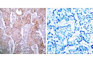 Immunohistochemical analysis of paraffin- embedded breast carcinoma, using EGFR (Phospho-Ser1070) Antibody. (EGFR antibody  (pSer1070))