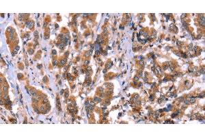 Immunohistochemistry of paraffin-embedded Human breast cancer tissue using HRG Polyclonal Antibody at dilution 1:50 (HRG antibody)