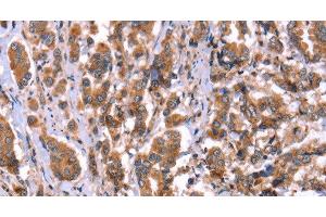 Immunohistochemistry of paraffin-embedded Human breast cancer tissue using HRG Polyclonal Antibody at dilution 1:50 (HRG antibody)