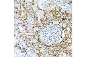 Immunohistochemistry of paraffin-embedded human lung cancer using MUC1 Rabbit mAb (ABIN7268687) at dilution of 1:100 (40x lens). (MUC1 antibody)