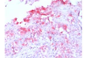 Formalin-fixed, paraffin-embedded human Melanoma stained with MART-1 Rabbit Recombinant Monoclonal Antibody (MLANA/1761R) (AP-Fast Red). (Recombinant MLANA antibody)