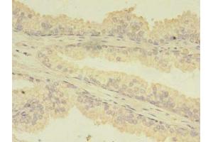 Immunohistochemistry of paraffin-embedded human prostate cancer using ABIN7173738 at dilution of 1:100 (TBCA antibody  (AA 2-108))