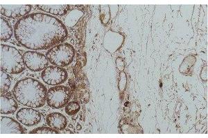 Immunohistochemistry of paraffin-embedded Human colon carcinoma tissue using HSPA5 Monoclonal Antibody at dilution of 1:200. (GRP78 antibody)