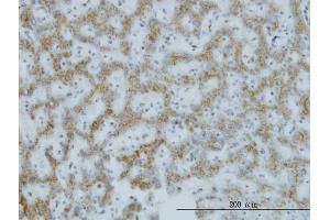 Immunoperoxidase of monoclonal antibody to C1GALT1 on formalin-fixed paraffin-embedded human hepatocellular carcinoma. (C1GALT1 antibody  (AA 264-363))