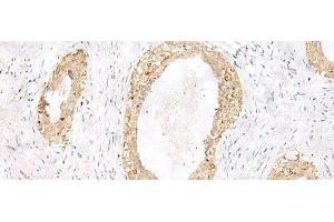 Immunohistochemistry of paraffin-embedded Human breast cancer tissue using TOR1A Polyclonal Antibody at dilution of 1:35(x200) (TOR1A antibody)