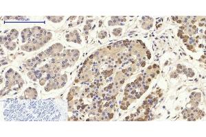 Immunohistochemistry of paraffin-embedded Human stomach cancer tissue using CD284 Polyclonal Antibody at dilution of 1:200. (TLR4 antibody)