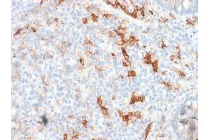 Formalin-fixed, paraffin-embedded human Melanoma stained with NGFR Rabbit Recombinant Monoclonal Antibody (NGFR/1997R). (Recombinant NGFR antibody)