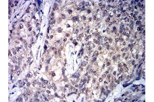 Immunohistochemical analysis of paraffin-embedded cervical cancer tissues using SDHB mouse mAb with DAB staining. (SDHB antibody  (AA 29-280))