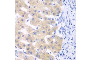 Immunohistochemistry of paraffin-embedded human liver cancer using CYP2C18 antibody. (CYP2C18 antibody  (AA 231-490))