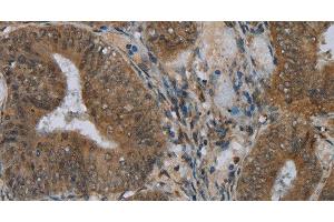 Immunohistochemistry of paraffin-embedded Human colon cancer using NAT10 Polyclonal Antibody at dilution of 1:40 (NAT10 antibody)