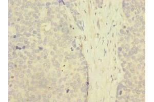 Immunohistochemistry of paraffin-embedded human gastric cancer using ABIN7176509 at dilution of 1:100 (ZNF77 antibody  (AA 51-369))