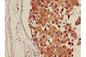 Immunohistochemistry of paraffin-embedded human breast cancer using ABIN7146220 at dilution of 1:100 (CDH18 antibody  (AA 66-251))