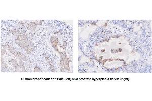 Paraffin embedded sections of human breast cancer and prostate hyperplasia tissue were incubated with anti-human STEAP1 (1:50) for 2 hours at room temperature. (STEAP1 antibody  (AA 1-70))