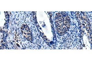 Immunohistochemistry of paraffin-embedded Human cervical cancer tissue using TRIM23 Polyclonal Antibody at dilution of 1:55(x200) (TRIM23 antibody)