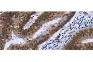 Immunohistochemistry of paraffin-embedded Human colon cancer tissue using HMGA1 Polyclonal Antibody at dilution 1:30 (HMGA1 antibody)