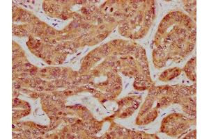 IHC image of ABIN7156114 diluted at 1:600 and staining in paraffin-embedded human liver cancer performed on a Leica BondTM system. (ILDR1 antibody  (AA 393-541))