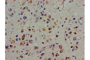 Immunohistochemistry of paraffin-embedded human glioma using ABIN7166444 at dilution of 1:100 (PTK2B antibody  (AA 707-875))