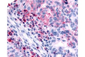 Anti-HRH4 / Histamine H4 Receptor antibody IHC of human Ovary, Carcinoma and Inflammatory Cells. (HRH4 antibody  (Cytoplasmic Domain))