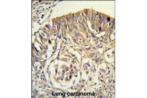 Formalin-fixed and paraffin-embedded human lung carcinoma reacted with PLTP Antibody , which was peroxidase-conjugated to the secondary antibody, followed by DAB staining. (PLTP antibody  (C-Term))