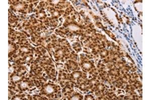 The image on the left is immunohistochemistry of paraffin-embedded Human thyroid cancer tissue using ABIN7130740(PSMD3 Antibody) at dilution 1/25, on the right is treated with fusion protein. (PSMD3 antibody)