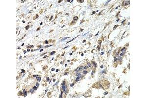 Immunohistochemistry of paraffin-embedded Human breast cancer using BUB1B Polyclonal Antibody at dilution of 1:200 (40x lens). (BUB1B antibody)