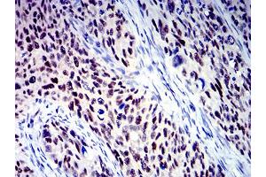 Immunohistochemical analysis of paraffin-embedded cervical cancer tissues using BCL9L mouse mAb with DAB staining. (BCL9L antibody  (AA 606-751))