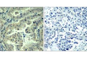 Immunohistochemical analysis of paraffin-embedded human lung carcinoma tissue using eIF4G (phospho-Ser1232) antibody (E011514). (EIF4G1 antibody  (pSer1232))