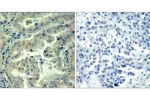 Immunohistochemical analysis of paraffin-embedded human lung carcinoma tissue using eIF4G (phospho-Ser1232) antibody (E011514).